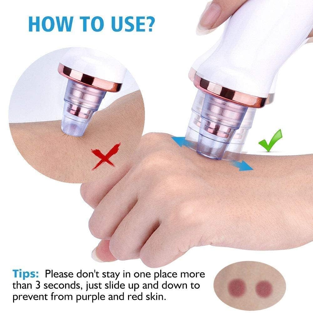 blackhead remover