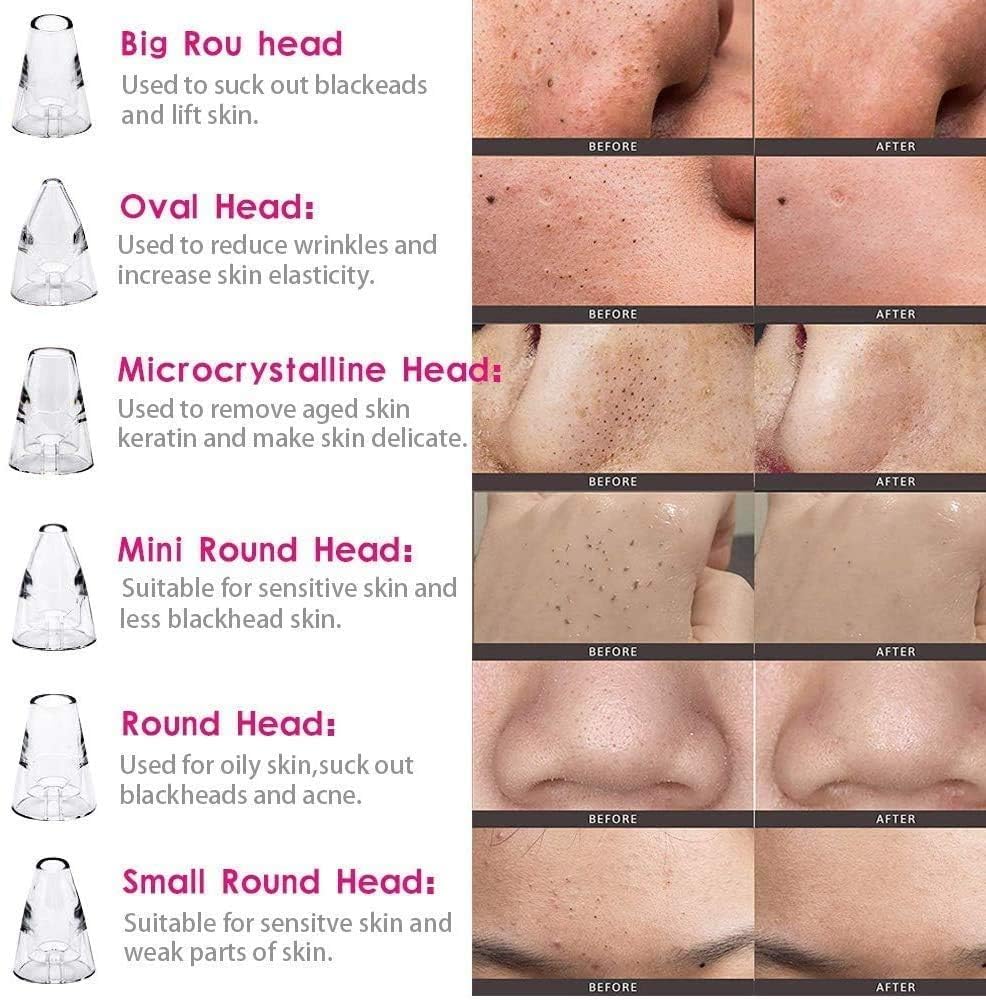 blackhead remover