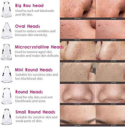blackhead remover