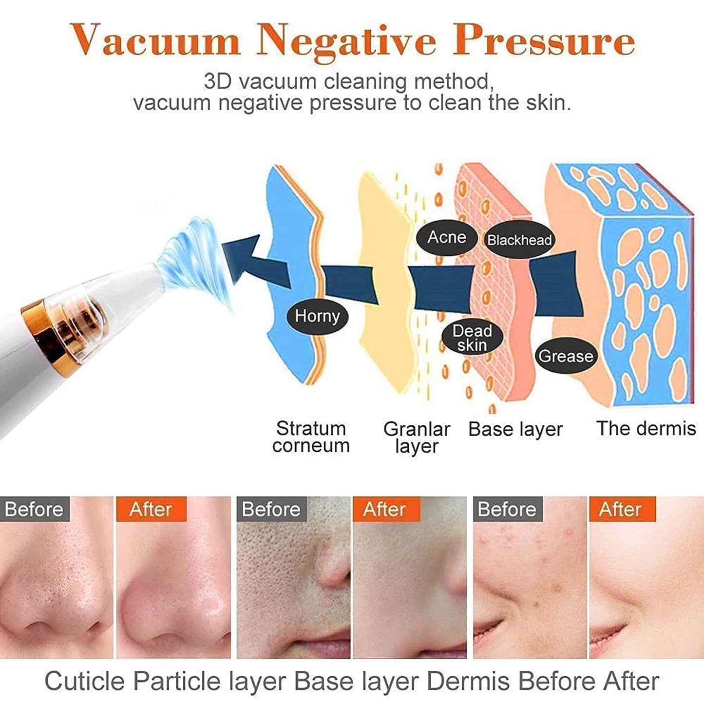 blackhead remover
